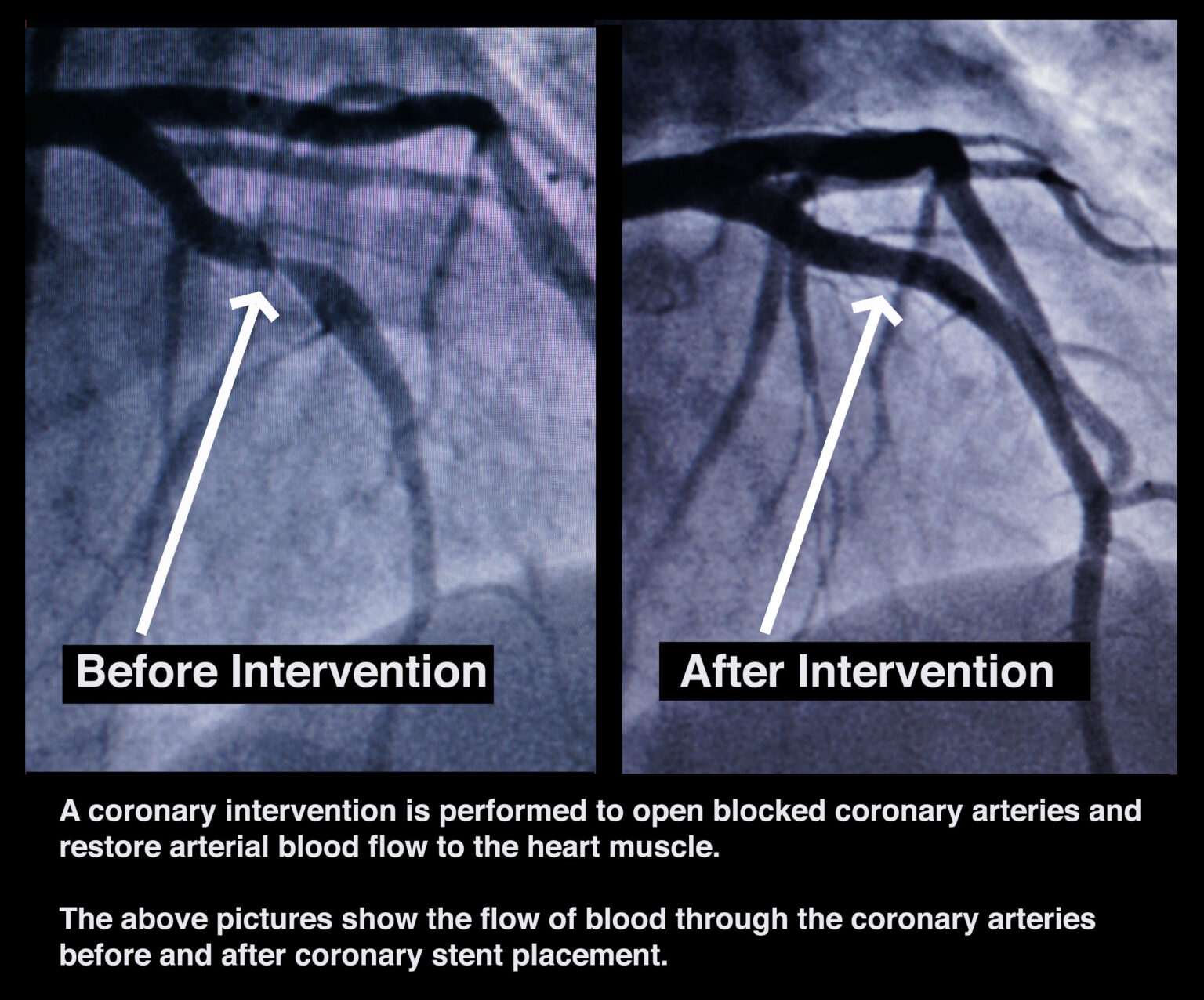 Coronary Angiogram Stent Placement New York Comprehensive Cardiology